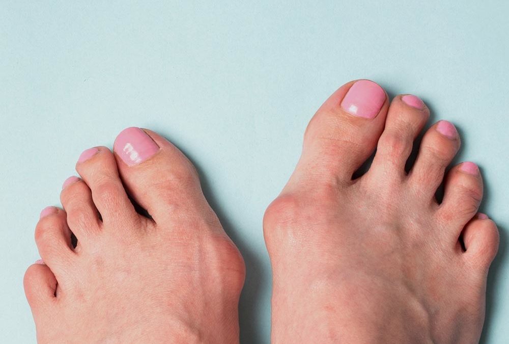 Bien Traiter un Hallux Valgus