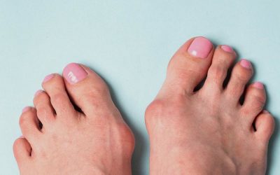 Bien Traiter un Hallux Valgus